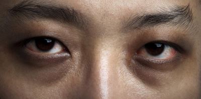 Dry eye disease and diabetes: new study reveals scale of issue and need for screening
