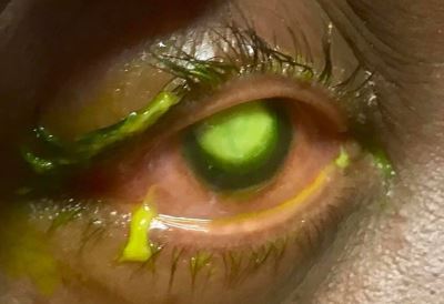 Ophthalmologist Dr. Patrick Vollmert shares graphic pics to warn against sleeping in contacts